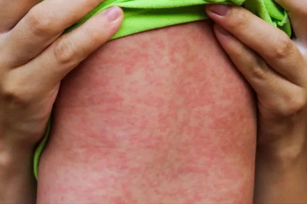 Measles