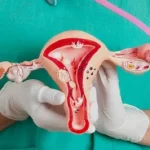Living with PCOS