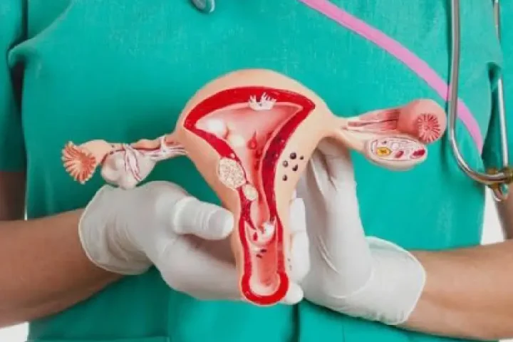 Living with PCOS