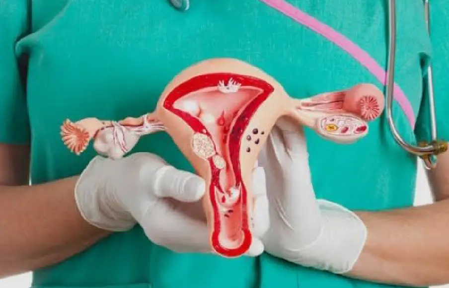 Living with PCOS