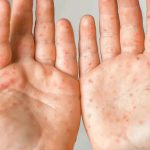 Measles vs Chickenpox