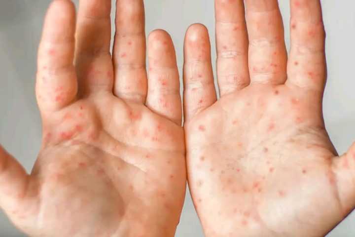 Measles vs Chickenpox